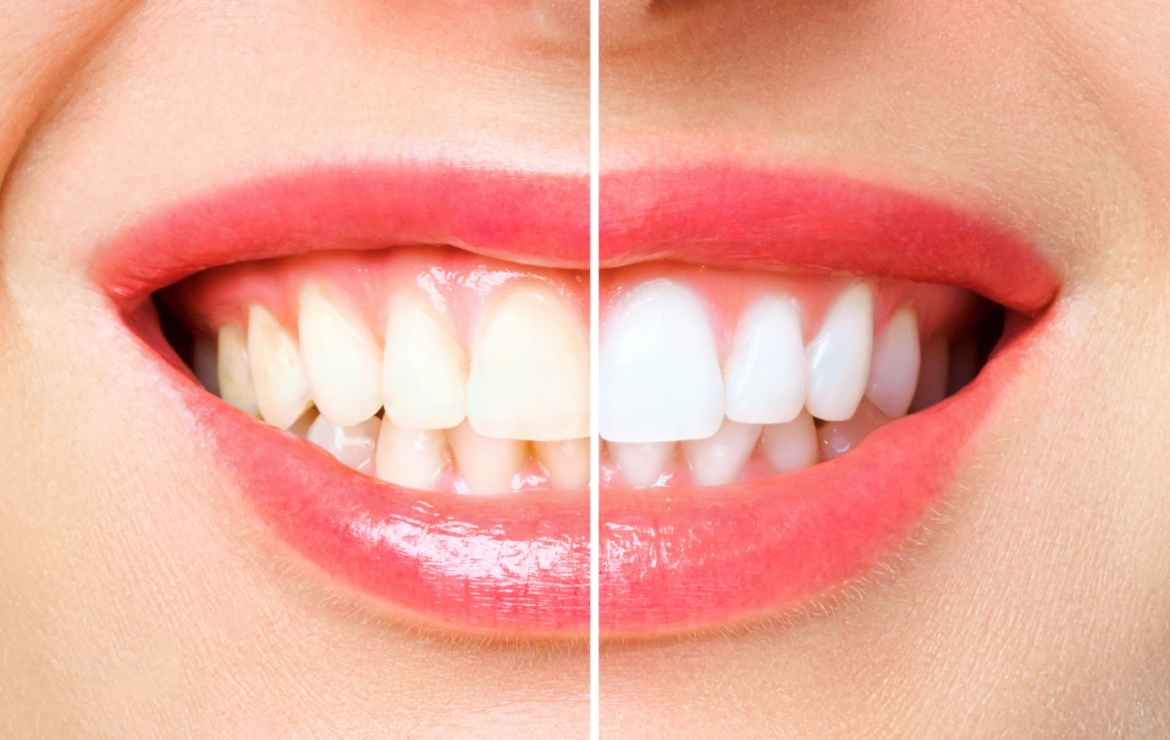 Why Professional Teeth Whitening is Better